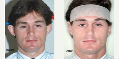 Ear Surgery before and after photo
