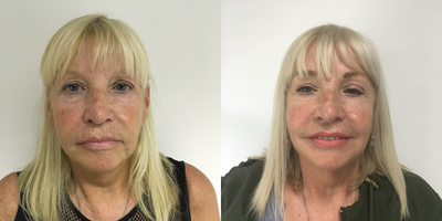 Thread Lift before and after photo