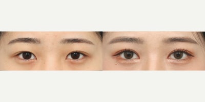Canthoplasty before and after photo