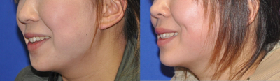Cheek Augmentation before and after photo