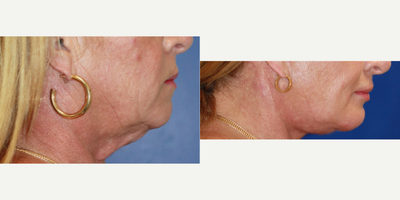 Chin Implant before and after photo