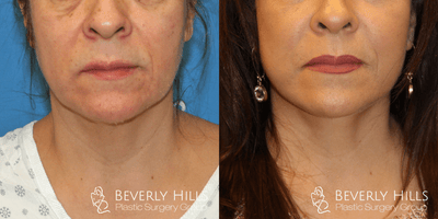 Facelift before and after photo