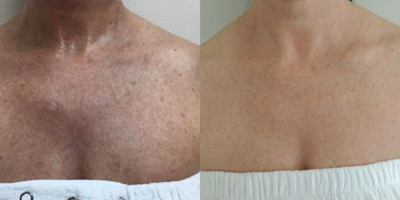 Fraxel Laser before and after photo