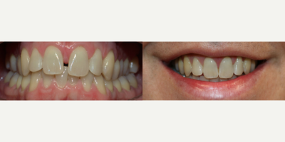 Invisalign before and after photo