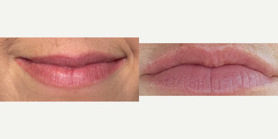 Laser Resurfacing before and after photo