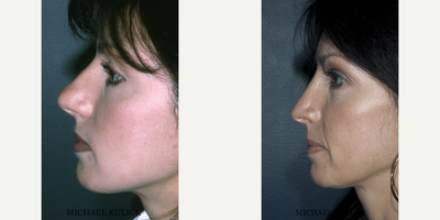 Rhinoplasty before and after photo