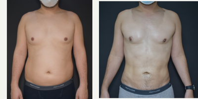 Abdominal Etching before and after photo