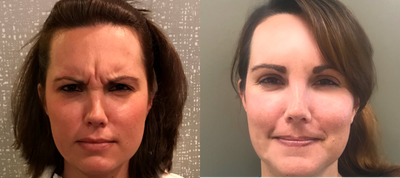 Botox before and after photo