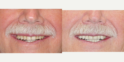 Dental Crown before and after photo