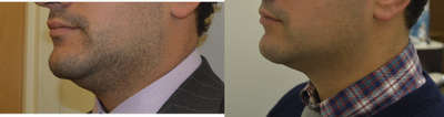 Kybella before and after photo