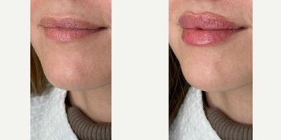 Lip Fillers before and after photo