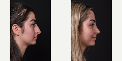 Septoplasty before and after photo