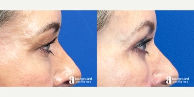 Eyelid Surgery before and after photo