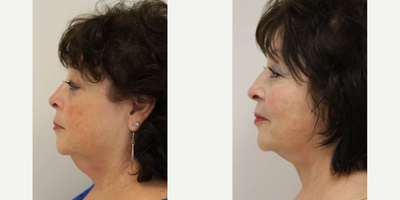 Facelift before and after photo