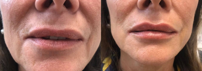 Juvederm before and after photo