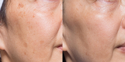 Laser Resurfacing before and after photo