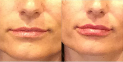 Lip Fillers before and after photo