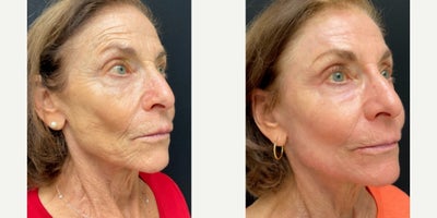 Facelift before and after photo