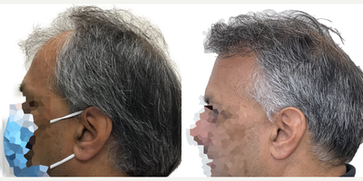 Hair Transplant before and after photo
