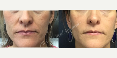 Juvederm before and after photo