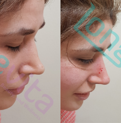 Dermal Fillers before and after photo