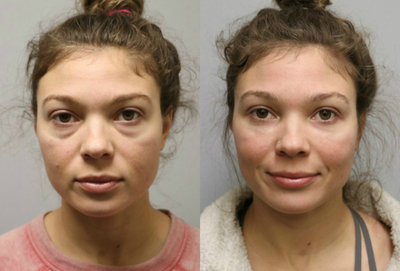 Eyelid Surgery before and after photo