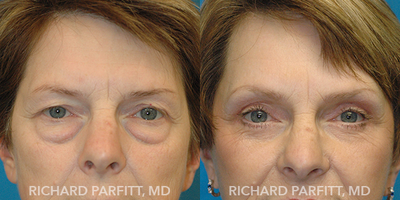 Brow Lift before and after photo