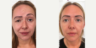 Emface before and after photo