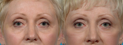 Laser Resurfacing before and after photo