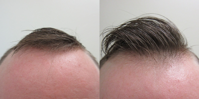 NeoGraft before and after photo
