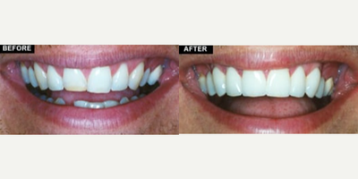 Porcelain Veneers before and after photo