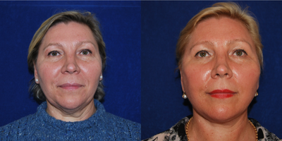 Brow Lift before and after photo