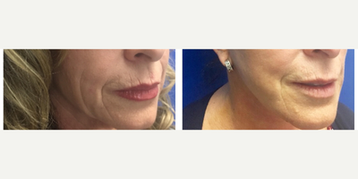 Facelift before and after photo