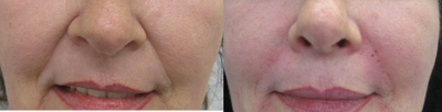 Juvederm before and after photo