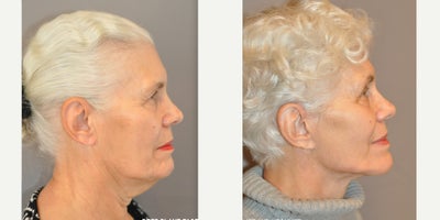 Neck Lift before and after photo