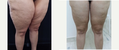 Body Lift before and after photo