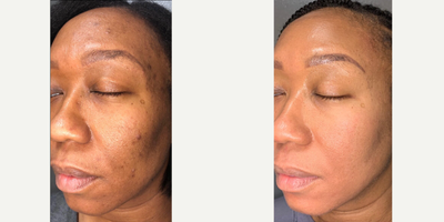 Facial before and after photo