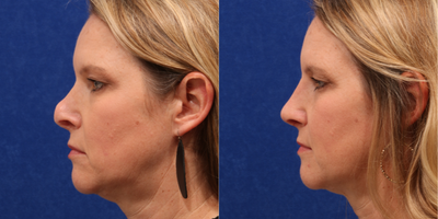 Revision Rhinoplasty before and after photo