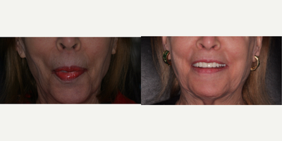 All-on-4 Dental Implants before and after photo