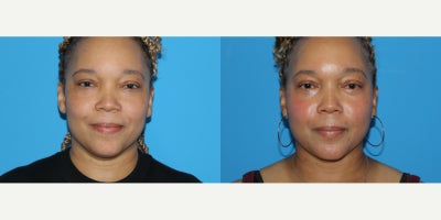 Chin Liposuction before and after photo