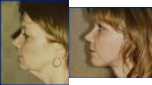 Facelift before and after photo