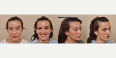 FUE Hair Transplant before and after photo