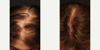 Hair Loss Treatment before and after photo