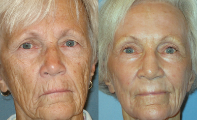 Laser Resurfacing before and after photo