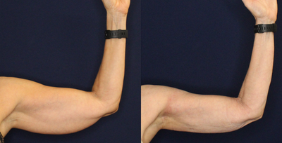 Arm Lift before and after photo