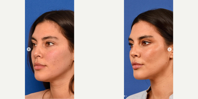 Dermal Fillers before and after photo