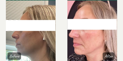 Dermal Fillers before and after photo
