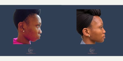 Genioplasty before and after photo