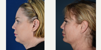 Kybella before and after photo