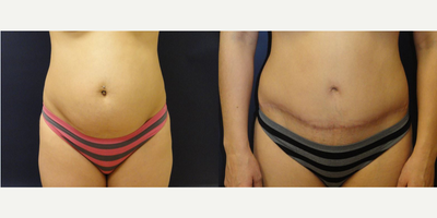 Tummy Tuck before and after photo